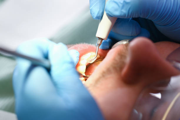Best After-Hours Dental Trauma Care in Candlewick Lake, IL