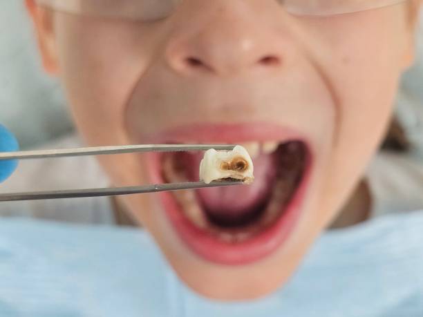Best Emergency Treatment for Dental Infections or Abscesses in Candlewick Lake, IL