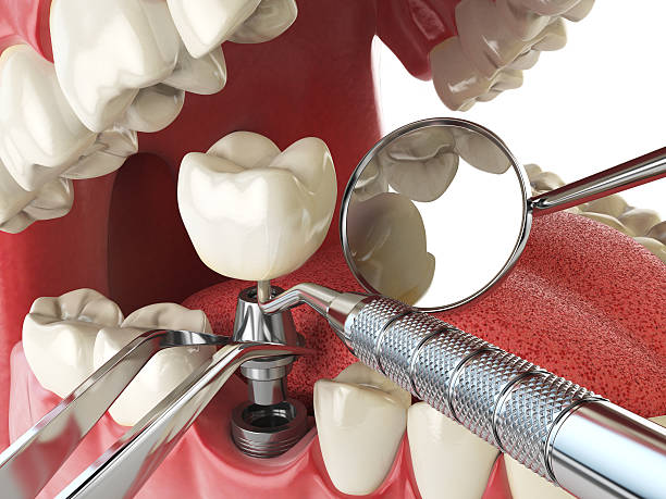 Best Emergency Treatment for Dental Infections or Abscesses in Candlewick Lake, IL